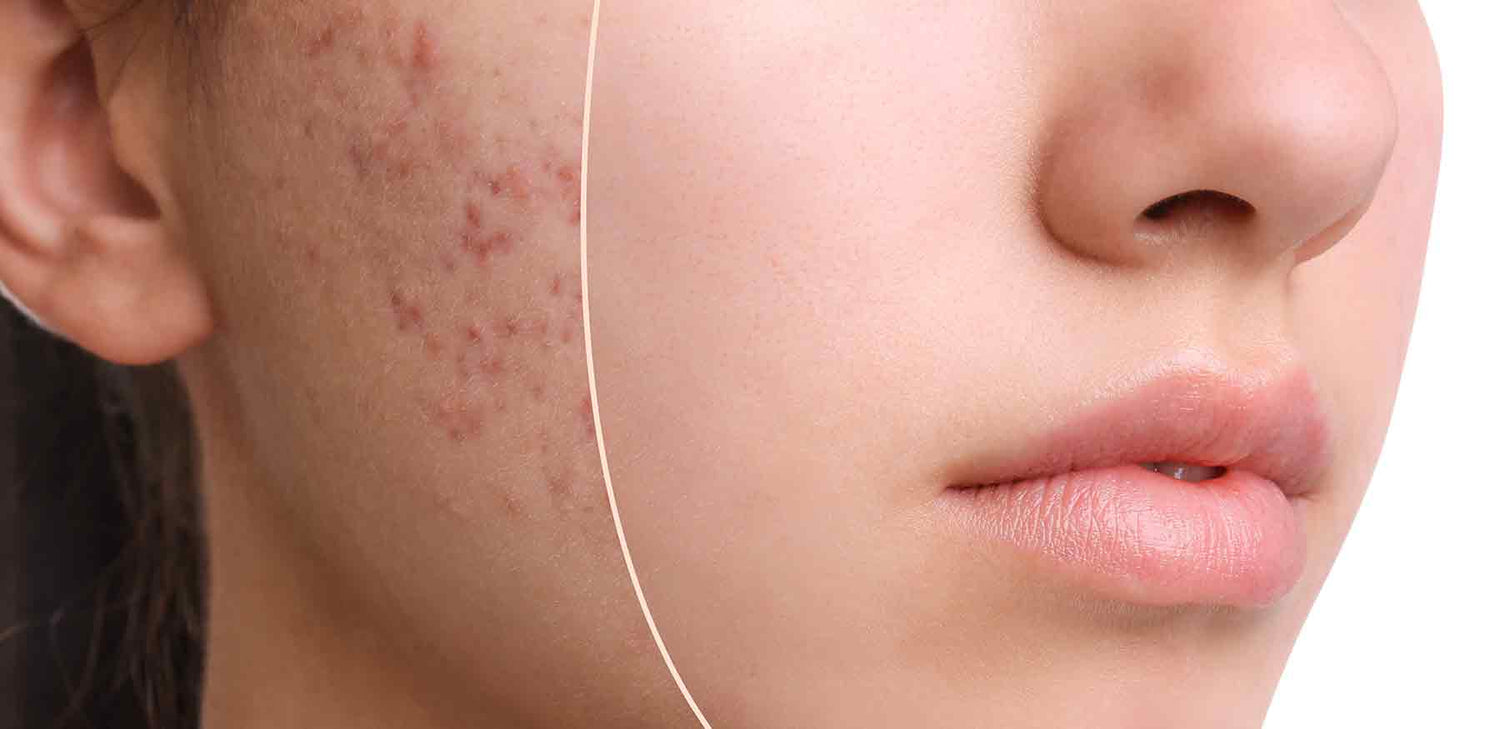 Kompletter K-Beauty-Leitfaden: Wie man mit Akne und Narben umgeht + Top-Inhaltsstoffe und Produkte-Wonder Skin