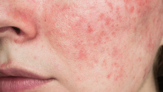 Geschädigte Hautbarriere: Anzeichen, Ursachen und die besten K-Beauty Tipps zur Heilung-Wonder Skin