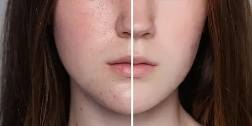 Trockene vs. dehydrierte Haut: Unterschied, Anzeichen und die richtige Pflege-Wonder Skin