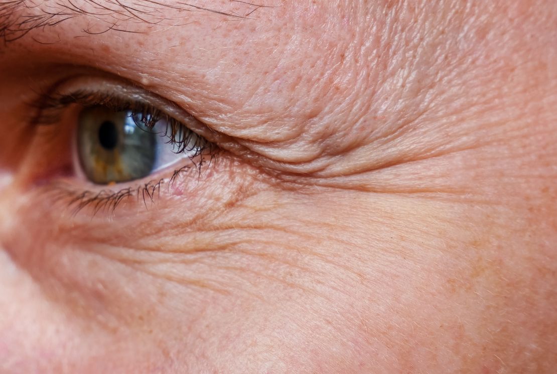 PDRN gegen Falten: Welche Falten wirklich besser werden – und welche nicht – Wonder Skin